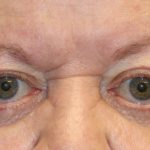 Orbital Decompression Before & After Patient #1229