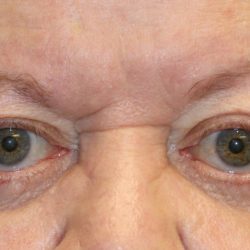 Orbital Decompression Before & After Patient #1229