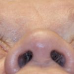 Orbital Decompression Before & After Patient #1229