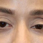 Orbital Fracture Before & After Patient #1227
