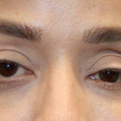 Orbital Fracture Before & After Patient #1227