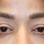 Orbital Fracture Before & After Patient #1227