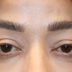 Orbital Fracture Before & After Patient #1227