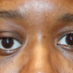 Orbital Tumor Before & After Patient #1232