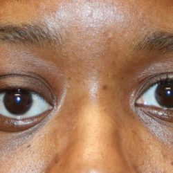 Orbital Tumor Before & After Patient #1232