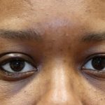 Orbital Tumor Before & After Patient #1232