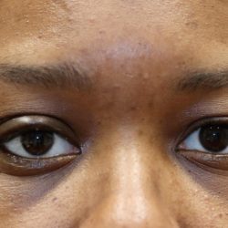 Orbital Tumor Before & After Patient #1232
