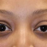 Eyelid Retraction Before & After Patient #1215