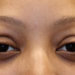 Eyelid Retraction Before & After Patient #1215