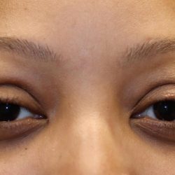 Eyelid Retraction Before & After Patient #1215