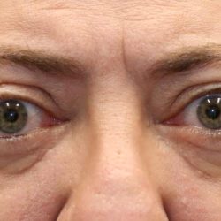 Orbital Decompression Before & After Patient #1231