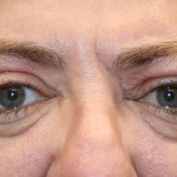Orbital Decompression Before & After Patient #1231