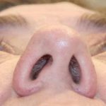 Orbital Decompression Before & After Patient #1231