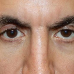 Orbital Fracture Before & After Patient #1226