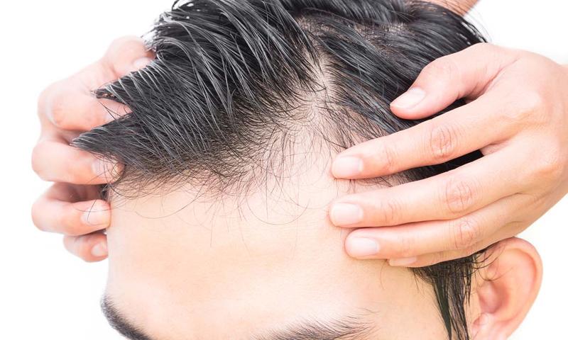 Hair Loss Treatment Options Northwestern Medicine